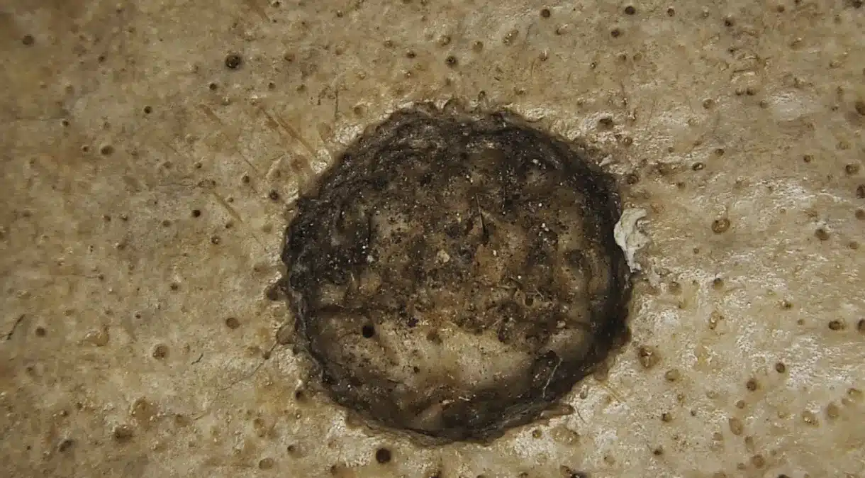 A foto mostra uma das lesões metastáticas com marcas de corte no crânio 236.