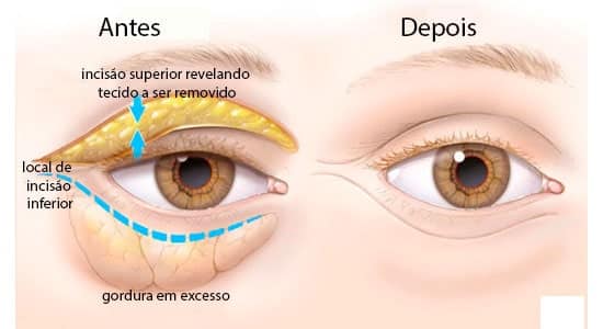 ilustração demonstrando como é realizada a cirurgia de blefaroplastia