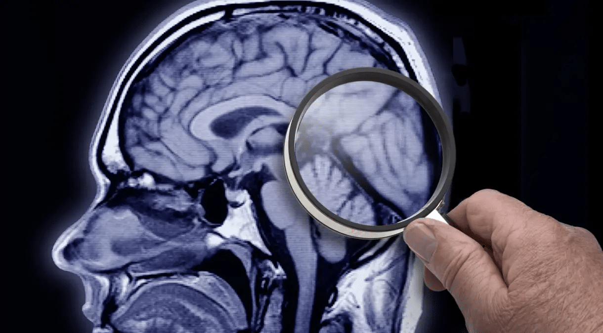 Respostas para Alzheimer pode estar em molécula descoberta no Brasil