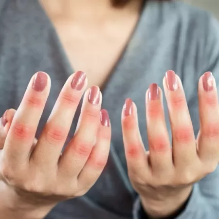 Lúpus: Novas Descobertas Revelam Possível Caminho para Tratamento