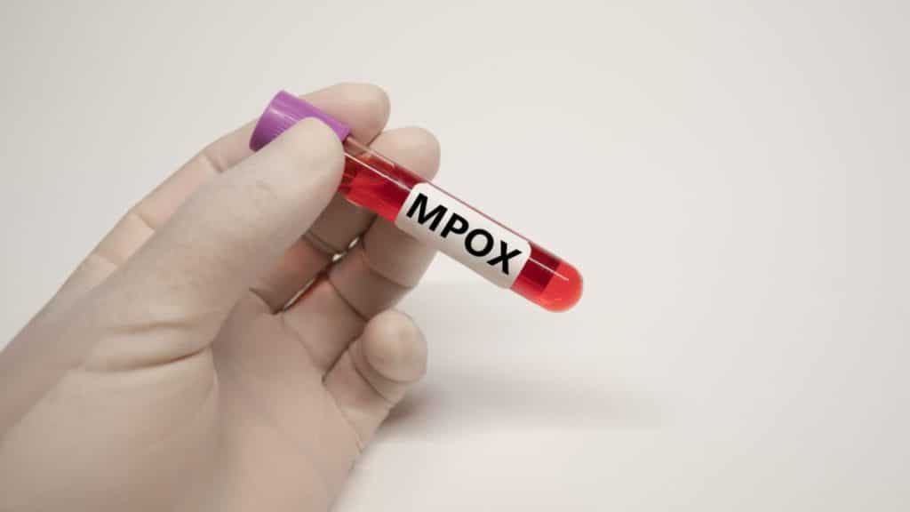Vírus mpoxx no Brasil. (Fonte: shutterstock).